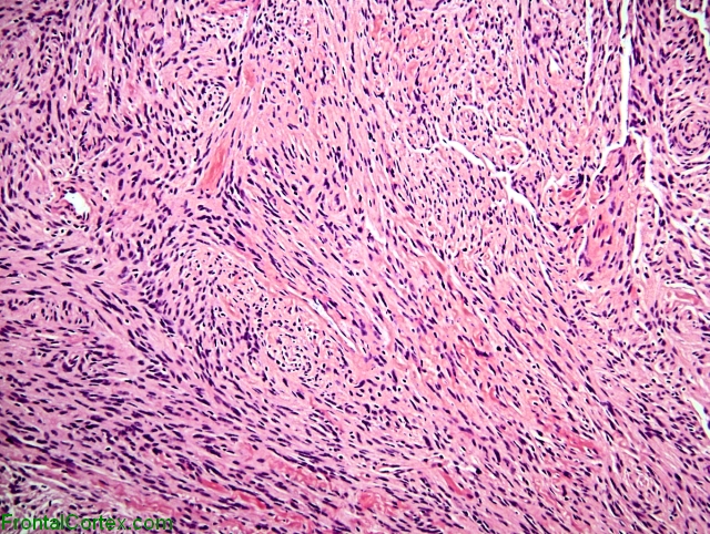 Tanycytic ependymomal of the posterior third ventricle, H&E stain x200